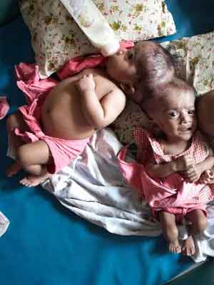 Cirurgiões esforçam-se para separar gêmeas unidas pelo cérebro (Fonte: AP - Site: (http://www.dailytelegraph.com.au/news/national/surgeons-still-operate-on-conjoined-twins/story-e6freuzr-1225798428846) Cirurgiões tentam separar as gêmeas Krishna and Trishna, 3, de Bangladesh. Fonte: AP (http://www.dailytelegraph.com.au/news/national/surgeons-still-operate-on-conjoined-twins/story-e6freuzr-1225798428846)