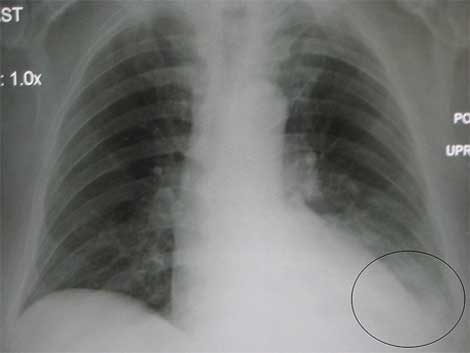 Raios X de tórax mostrando a evidência de pneumonia no lóbulo inferior esquerdo. (foto: http://es.wikipedia.org/)